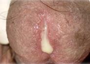 Discharge of Pus in gonorrhoea from the penis