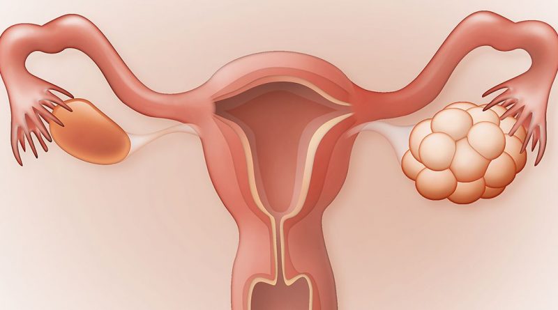 Managing Your PCOS and Its Complications