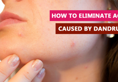 How to eliminate acne caused by dandruff