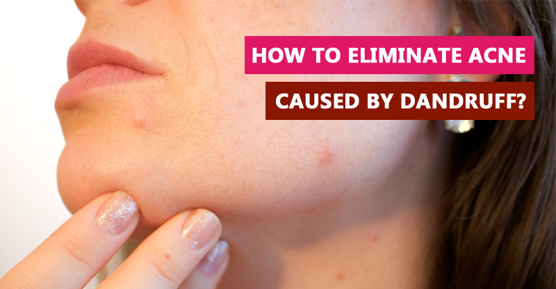 How to eliminate acne caused by dandruff