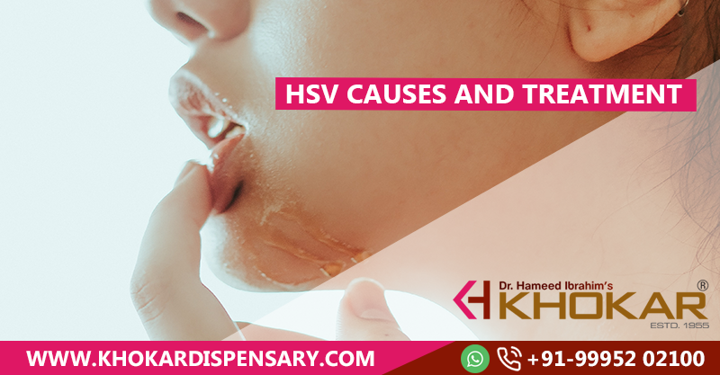 HSV Causes and Treatment