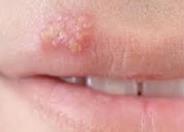 HSV1 – Oral Herpes