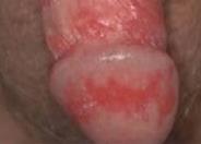 HSV2 – Genital Herpes