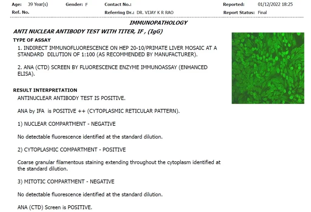 ANA Posititve Report Before Treatment